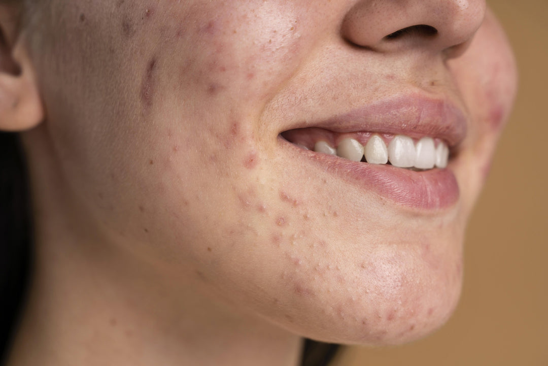 The Benefits of Ashwagandha for Acne-Prone Skin